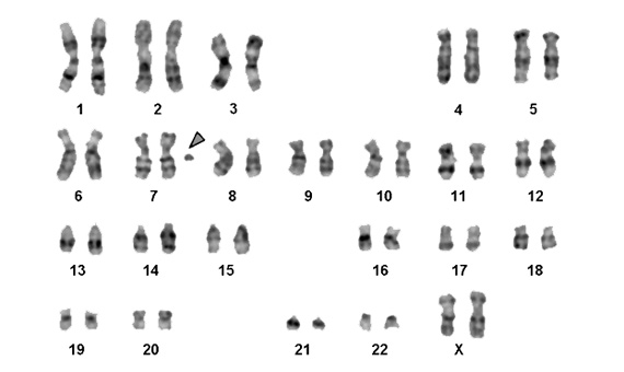 Karyotype of a person with the 46 standard chromosomes of our species plus a small fragment from chromosome 7 / Image: Al-Achkar, W et al.