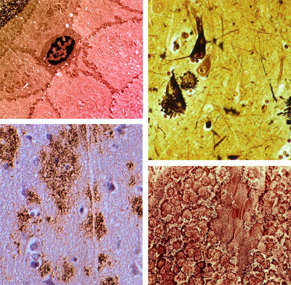 BBVA, OpenMind, Undoing Aging with Molecular and Cellular Damage Repair, De Gray, Clockwise, from top left: electronic micrograph showing the surface of epithelial cells from a human cornea; photomicrograph of the cerebral cortex of an Alzheimer patient; scanning electron micrograph of a human bronchus; and a photomicrograph of a section of the neocortex of an 86-year-old woman with Alzheimer’s disease.