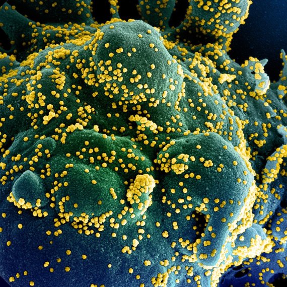 BBVA-OpenMind-Materia-Covid 19-Letalidad 4-Micrografía electrónica de barrido coloreada de una célula apoptótica (azul / verde) muy infectada con partículas del virus SARS-COV-2 (amarillo). Crédito: NIAID